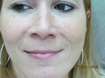 Restylane