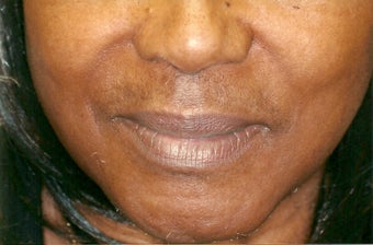 Restylane injection