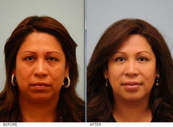 Restylane