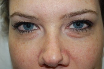 Restylane used in tear trough 