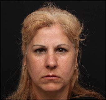Restylane & Juvederm