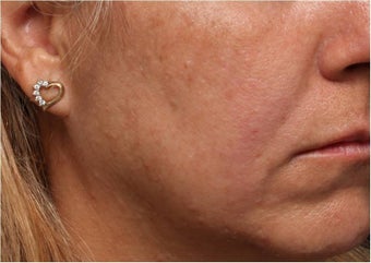 Restylane