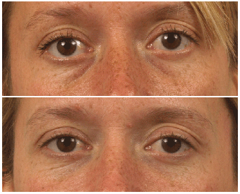 Restylane to Lower Eyelids/Tear-Trough