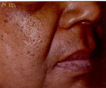 Restylane/Juvederm