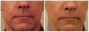 Restylane to Smile Lines