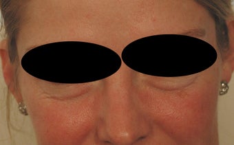 Restylane for Eye Bags