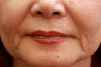 Fill the nasolabial folds and marionette lines