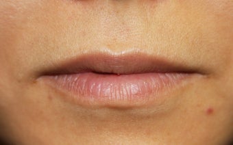 Lip Injection