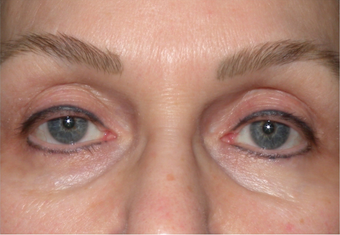 Tear trough filler