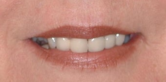 Smokers lines treated with Restylane and Botox in lips