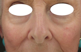 Midface, Cheeks, Tear troughs, and Nasolabial folds treated Restylane and Radiesse