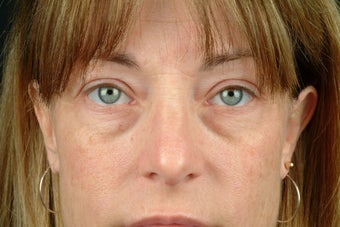 Restylane