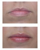 Restylane Injections for Lip Augmentation