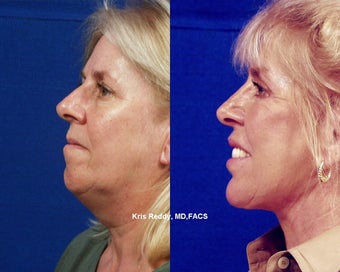 Restylane  with Facelift, Rhinoplasty, and Laser Resurfacing
