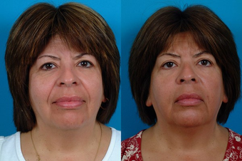 Restylane