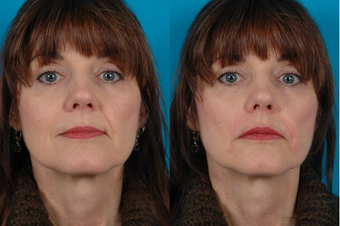 Restylane