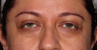 Undereye Filler Injection