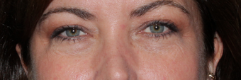 Restylane