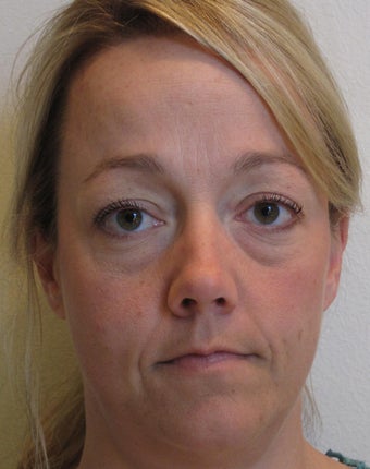 Dermal Filler