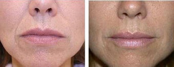 Restylane for nasal labial folds