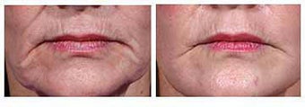 Restylane for wrinkles