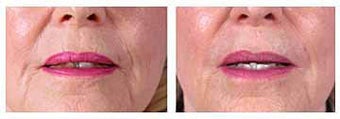 Restylane for wrinkles and marionette lines