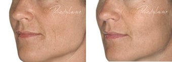 Before and after Restylane on fine lines