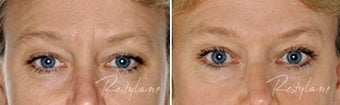 Before and after Restylane on fine lines