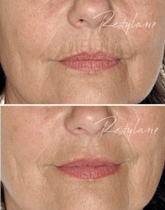 Before and after Restylane on fine lines