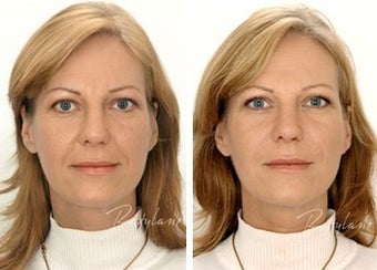Before and after restylane full face
