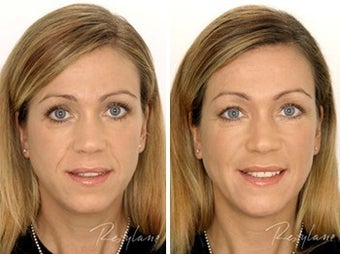 Before and after restylane full face