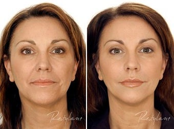 Restylane Full Face Treatment