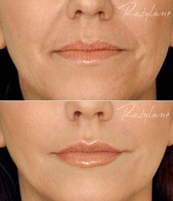 Restylane Lips Wrinkles Before After