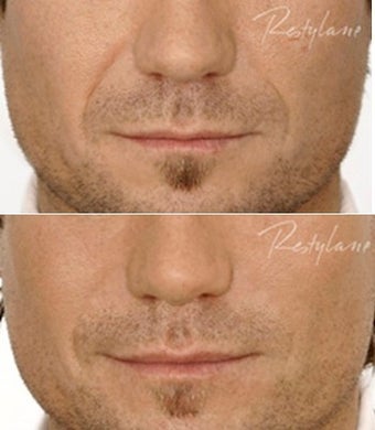 Restylane Male Nasolabial Folds Before After