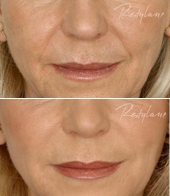 Restylane Nasolabial Folds Before After