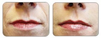 Before and after Restylane around mouth