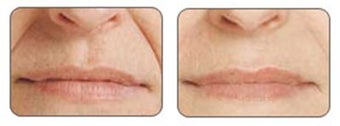 Before and after Restylane around mouth