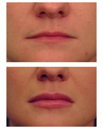 Restylane for lip augmentation