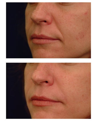 Juvederm
