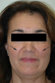 Restylane treatment for laugh lines  