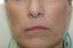 Restylane Treatment for lips