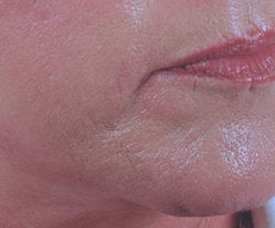 Chin rejuvenation 