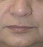 Restylane for marionette (mouth) lines