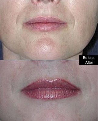 Lip Fillers
