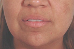 Restylane for laugh lines