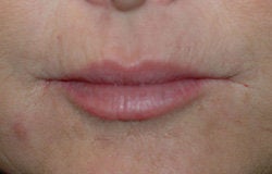 Restylane injections for upper lip lines 