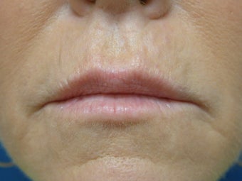 Restylane (Filler)
