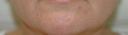 Restylane and Botox for mouth rejuvenation