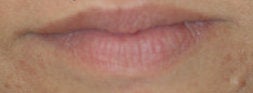 Lip enhancement with Restylane