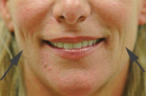 Restylane for cheek augmentation